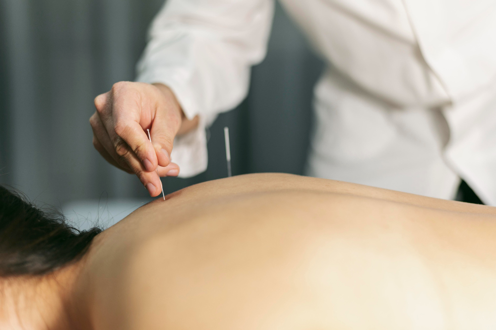 Électroacupuncture chez CVS Thérapies : Harmonie Traditionnelle et Technologie Moderne